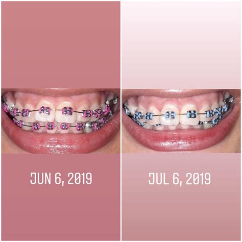 1 month braces transformation|One Month Braces (How Teeth Move In One Month .